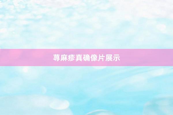 荨麻疹真确像片展示